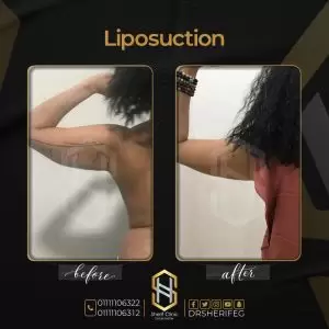 تقنية الفيزر لشفط الدهون
