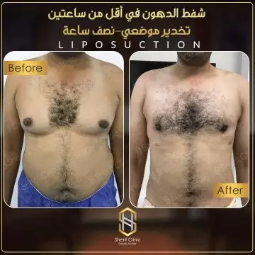تكلفة عملية شفط دهون البطن