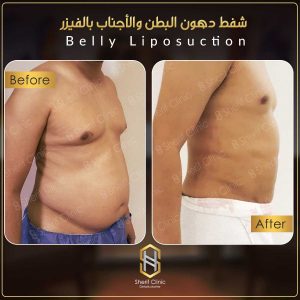 عملية شفط الدهون فى مصر