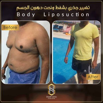 شفط الدهون من الارداف للرجال