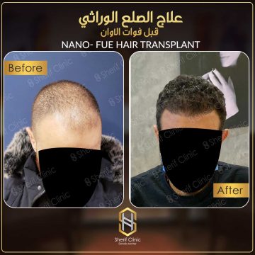 علاج الصلع الوراثي 2021