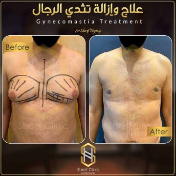 لبس المشد بعد عملية شفط الارداف