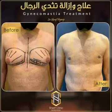 لبس المشد بعد عملية شفط الدهون