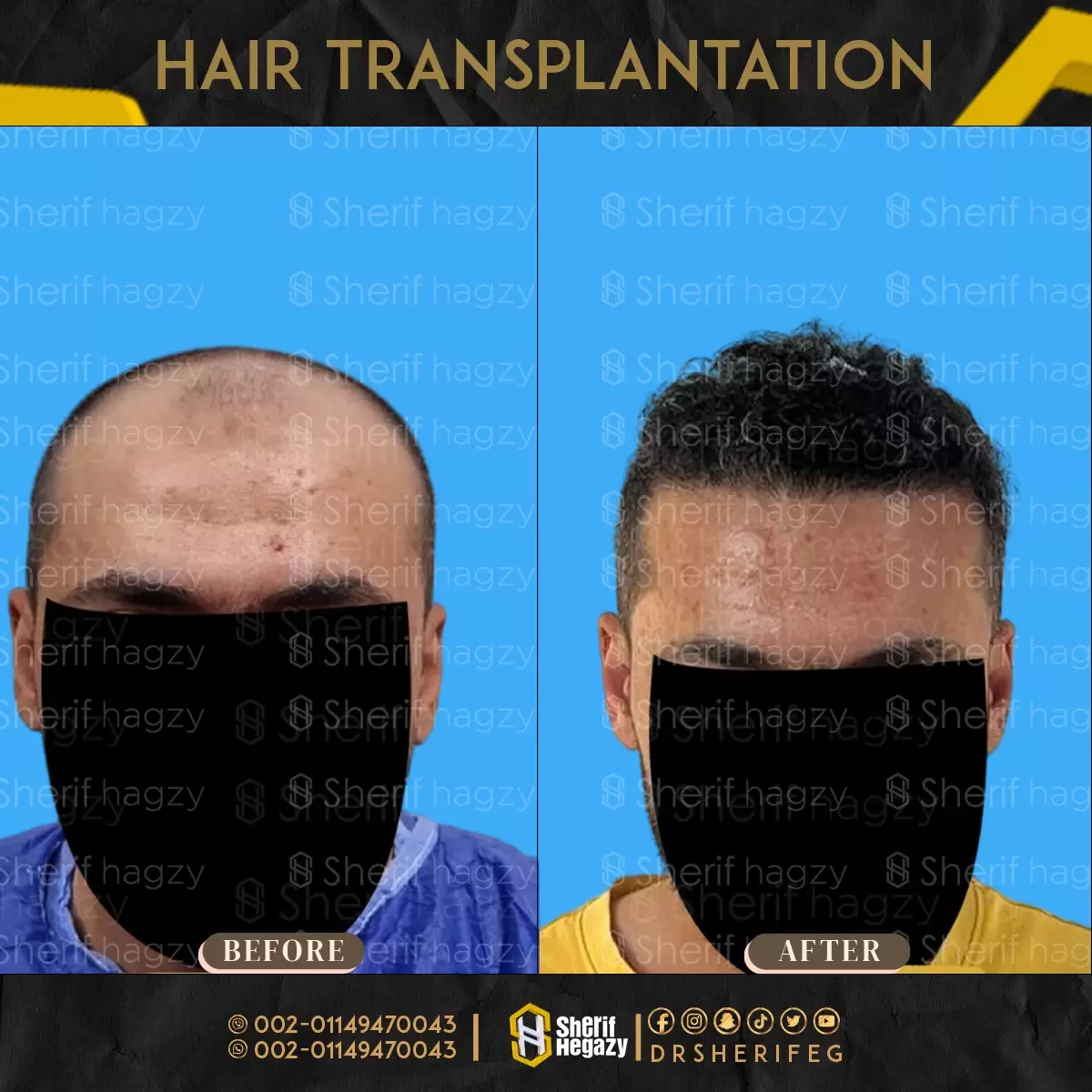 قبل-وبعد-زراعة-الشعر-الطبيعي