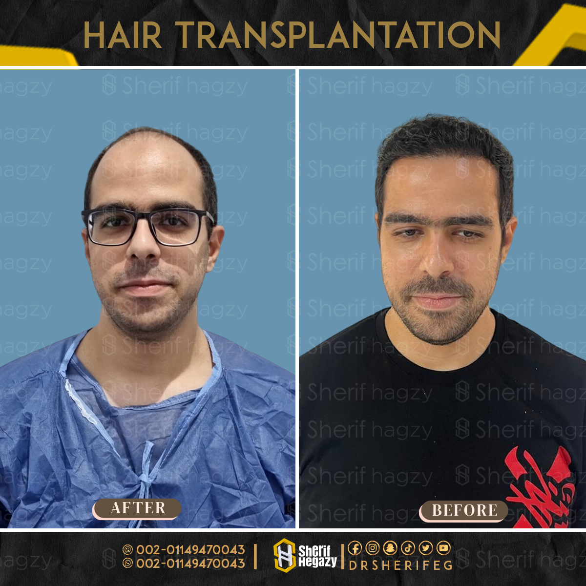 قبل-وبعد-زراعة-الشعر-الطبيعي