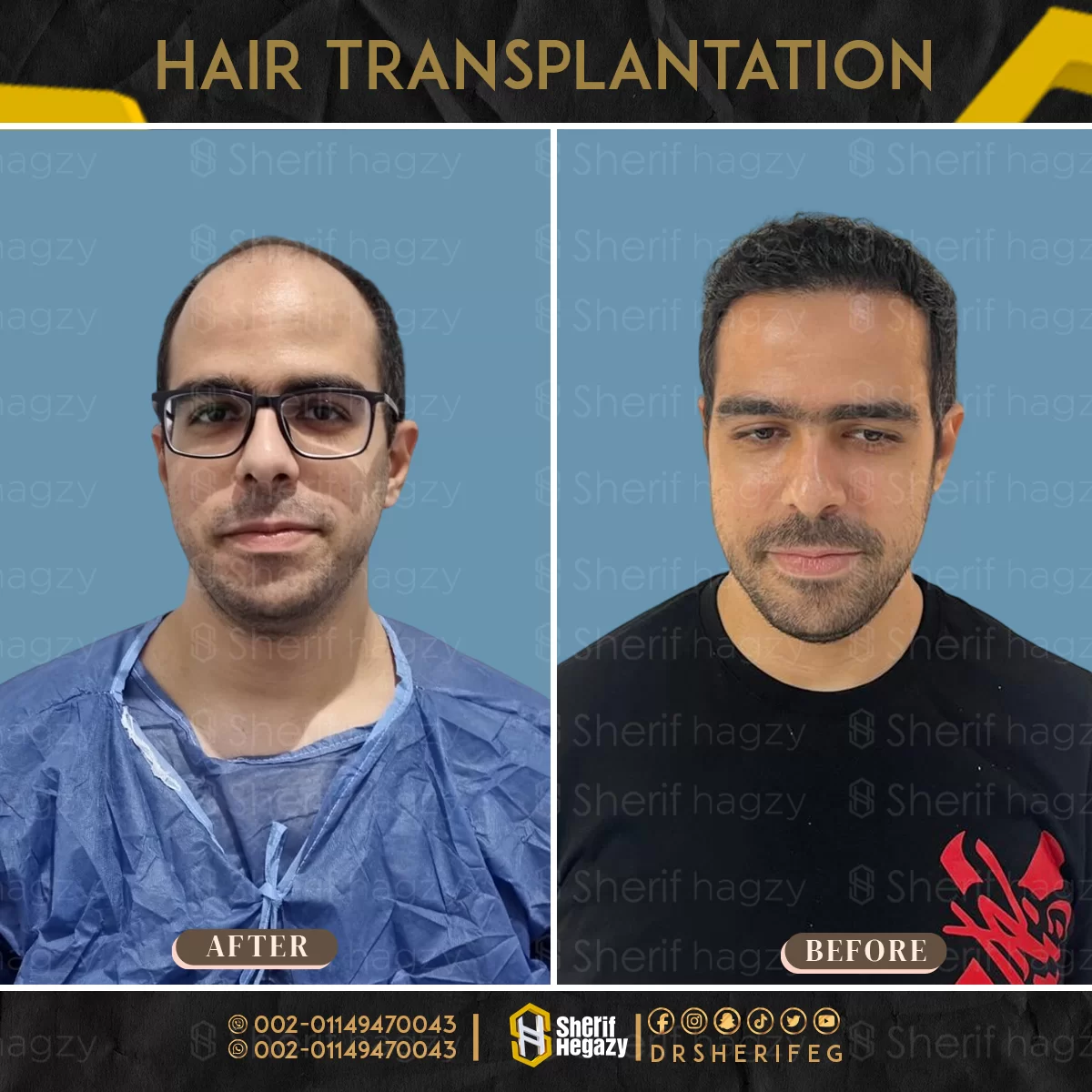 قبل-وبعد-زراعة-الشعر-الطبيعي