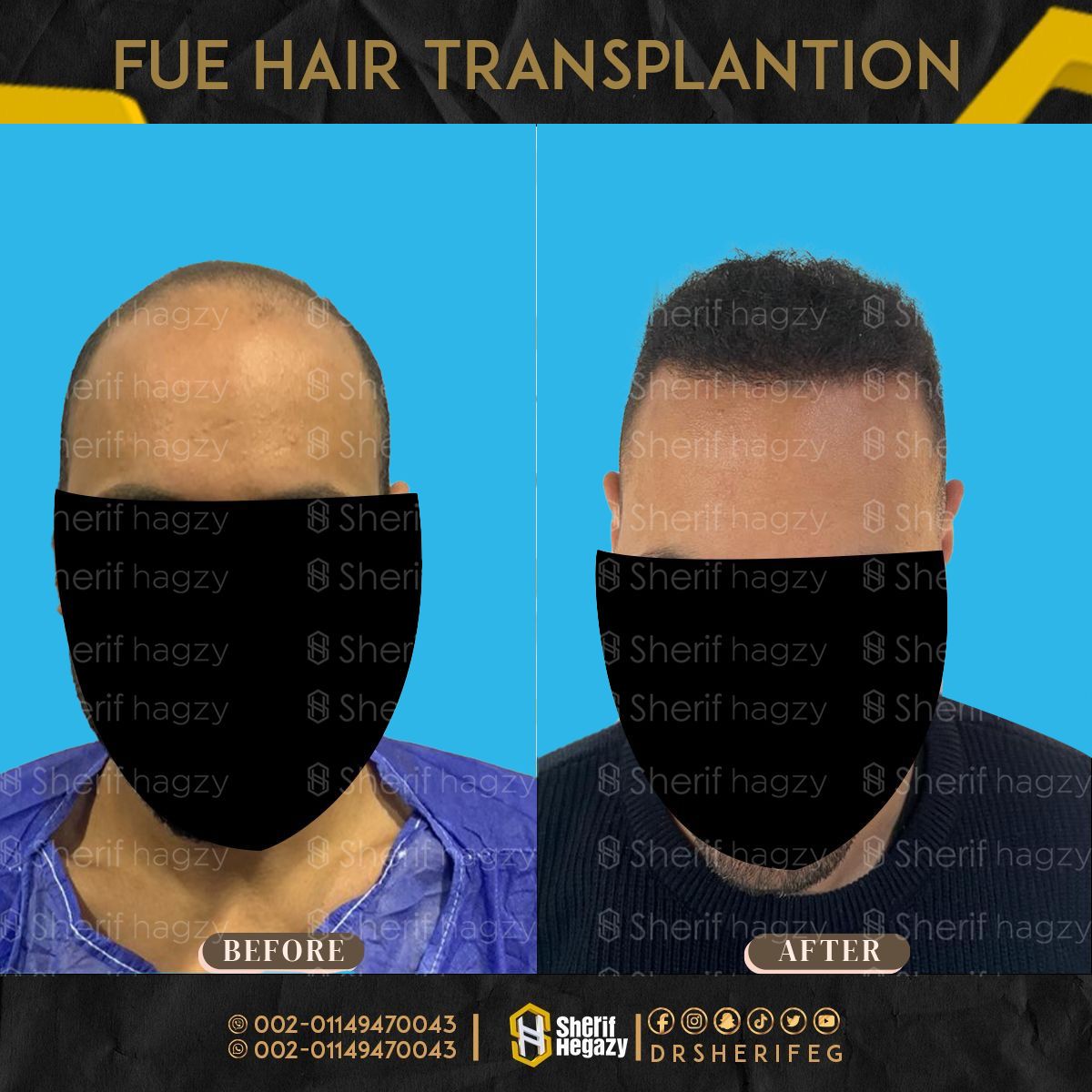 نتائج زراعة الشعر