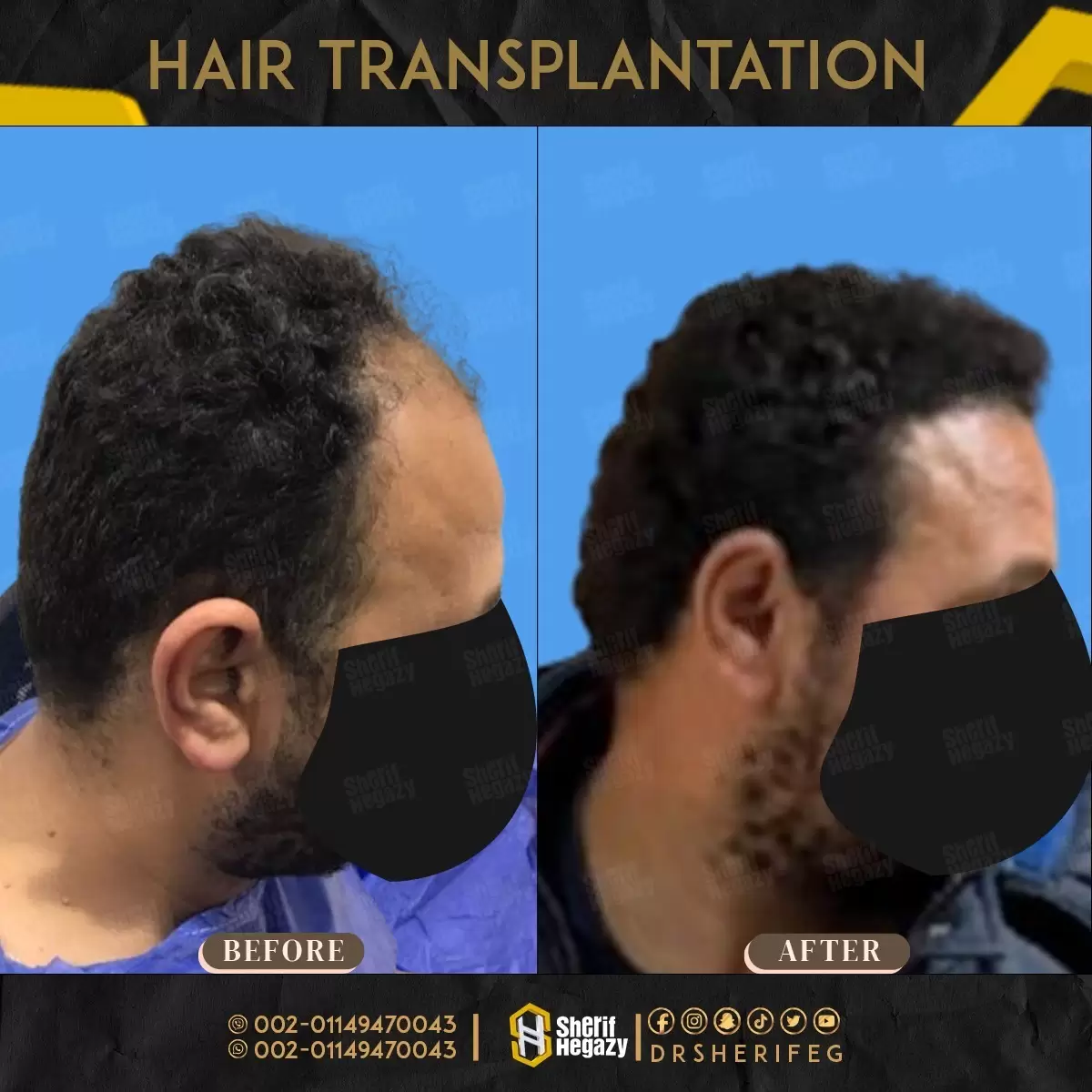 نتائج زراعة الشعر