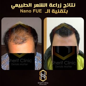 زرع الشعر بدون جراحة