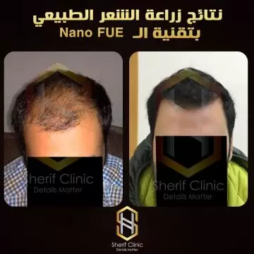 زرع الشعر بدون جراحة