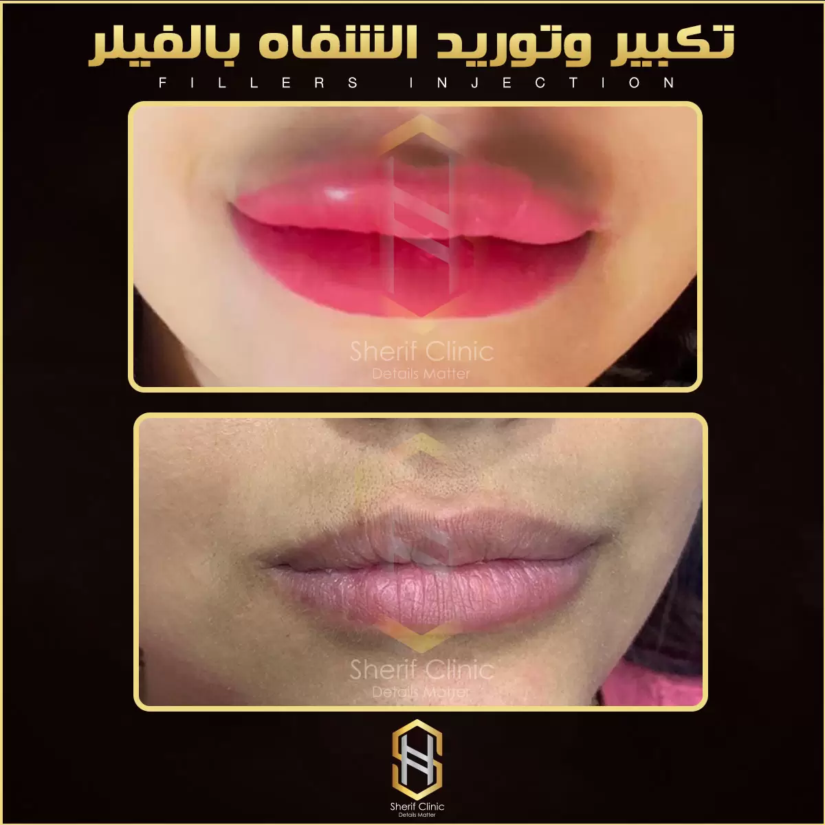 حقن الفيلر قبل وبعد