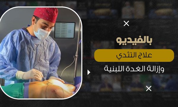 علاج تثدي الرجال