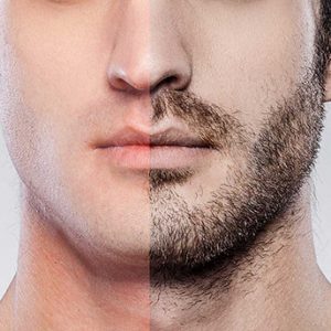 زراعة شعر الذقن