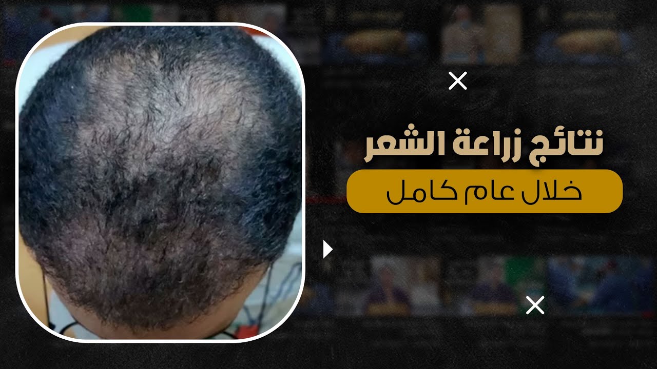 نتائج زراعة الشعر الطبيعي بتقنية الـ Nano-FUE