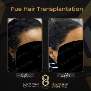 زراعة شعر أسود