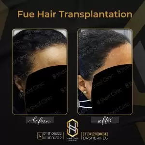 زراعة شعر أسود