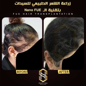 زرع الشعر بدون جراحة