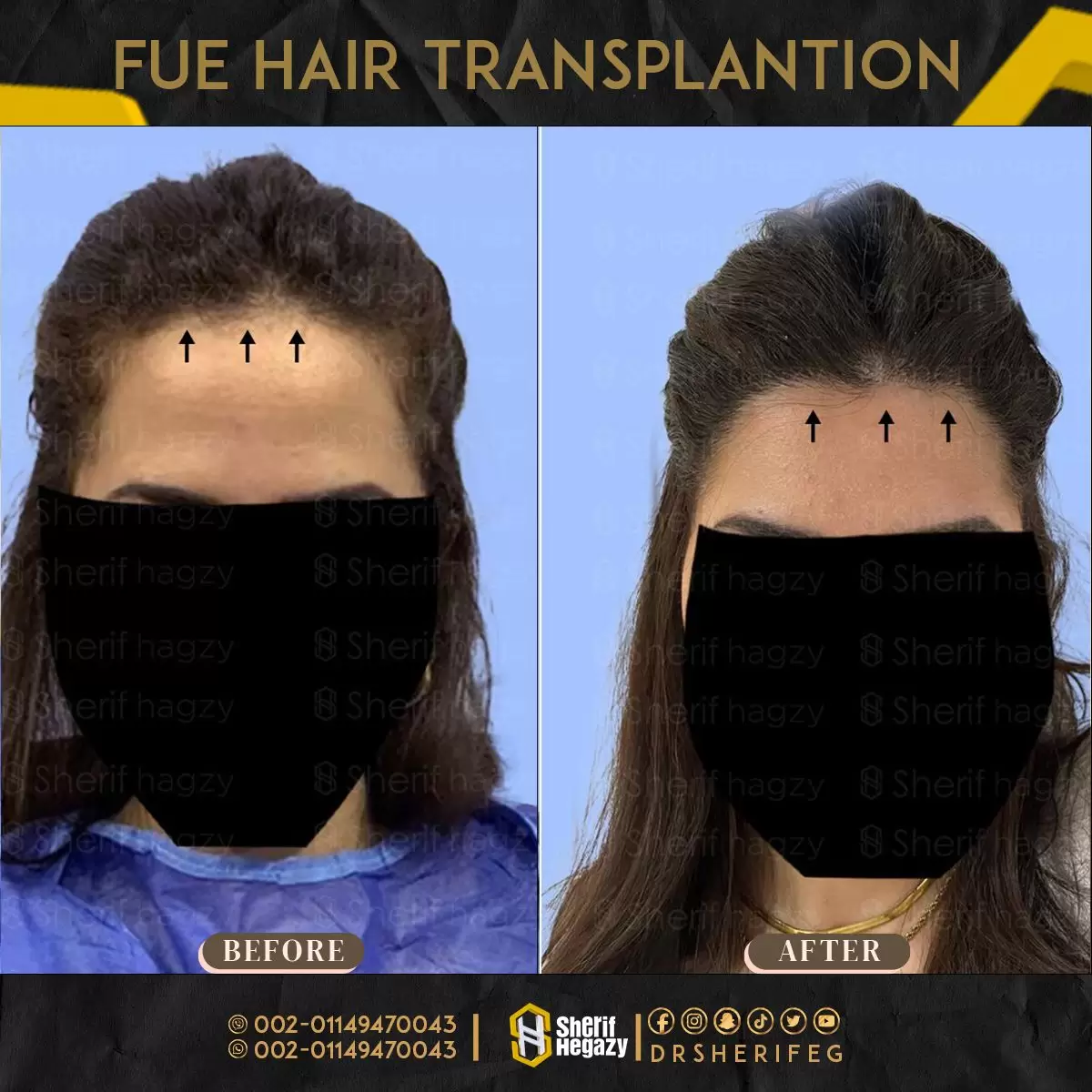 تصغير الجبهة للسيدات بزراعة الشعر الطبيعي