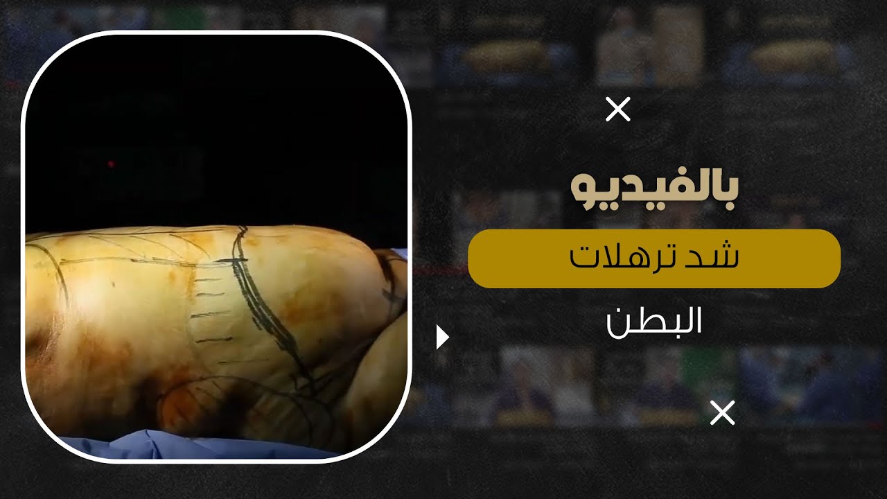 أسباب ترهلات الجسم