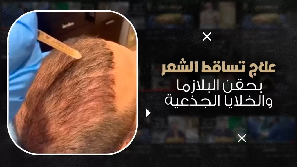الخلايا الجذعية للشعر