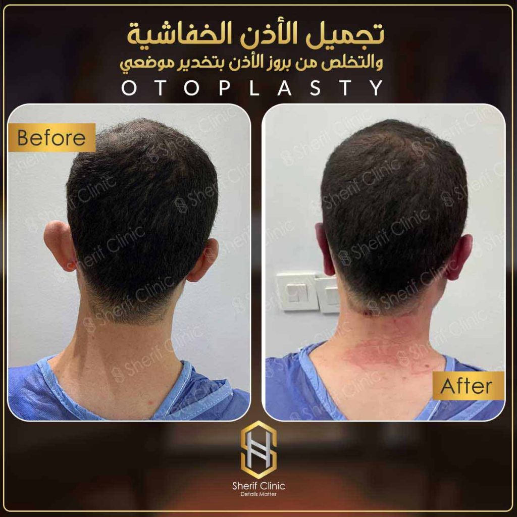 تجميل الأذن بدون جراحة