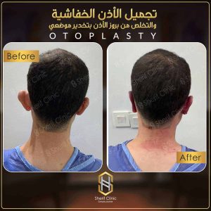 تجميل الأذن بدون جراحة