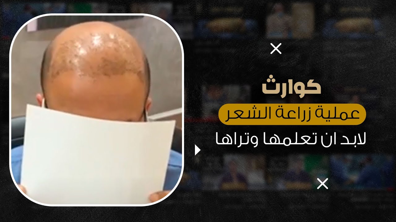 كوارث زراعة الشعر الطبيعي