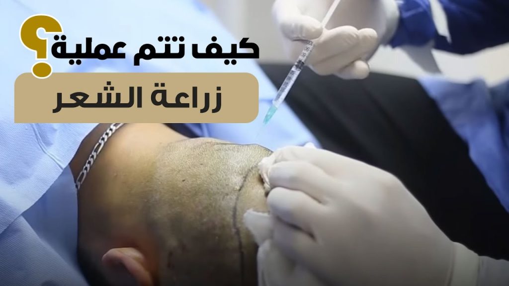 زراعة الشعر بالاقتطاف لصلع وراثي من درجه كبيرة