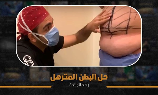 شد الجسم بعد علاج السمنة