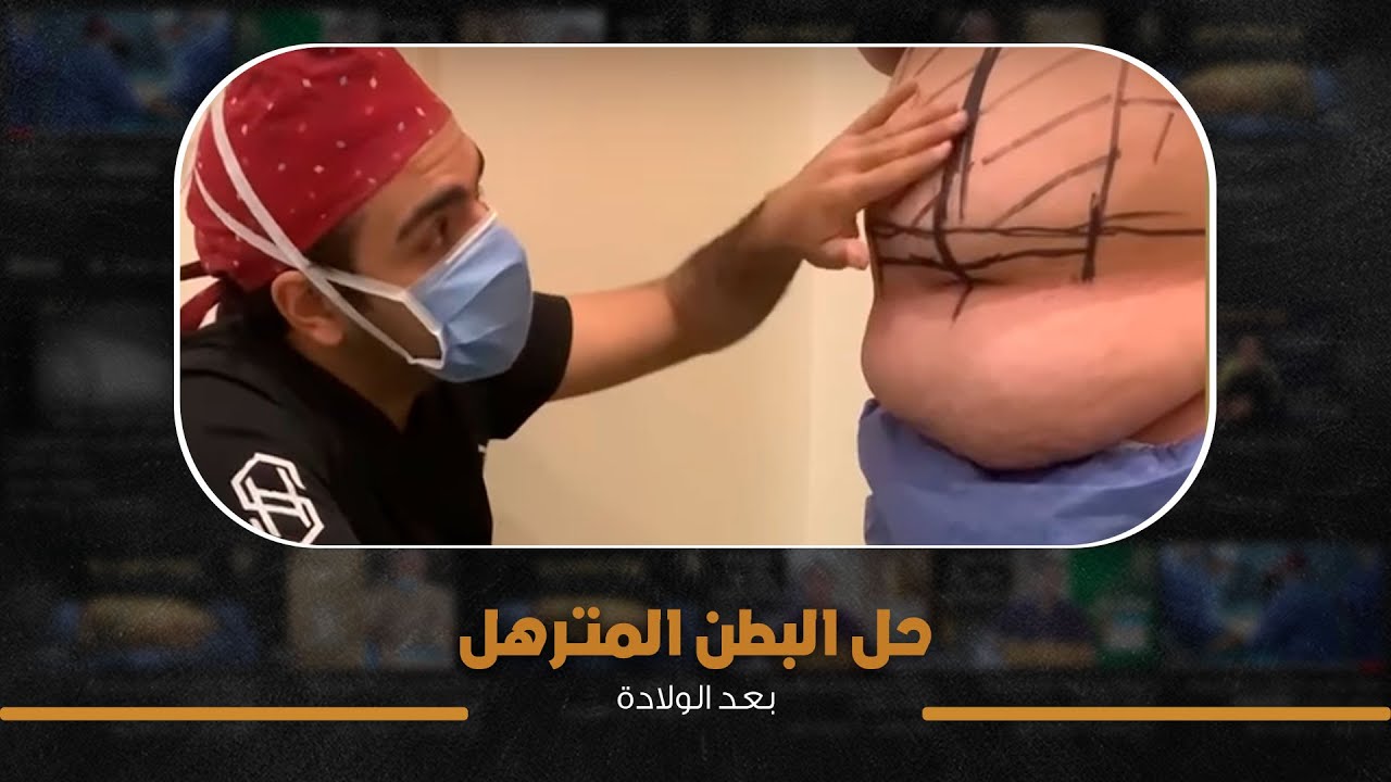 شد الجسم بعد علاج السمنة