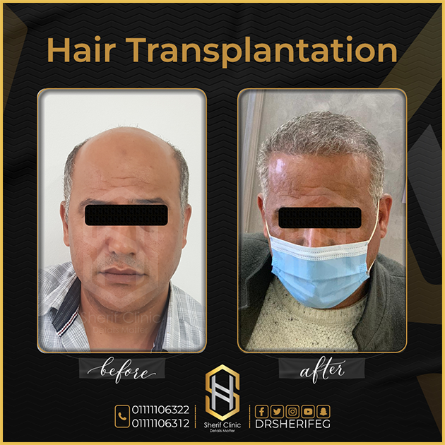 مراحل زراعة الشعر