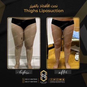 تنحيف الافخاذ