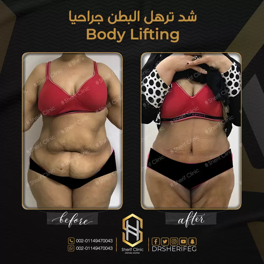 شد الترهلات قبل وبعد