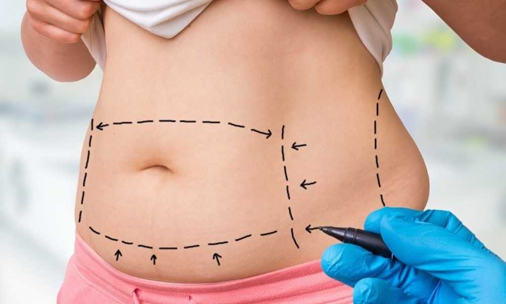 اسعار عمليات شفط الدهون