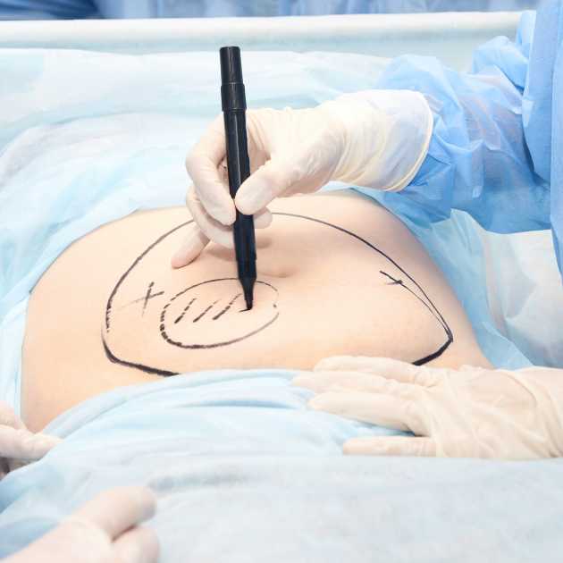 تجمع سوائل بعد عملية شفط الدهون