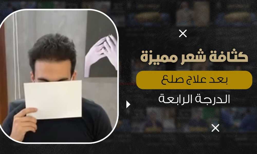 افضل علاج للصلع الوراثي