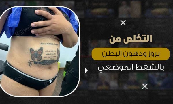 التخلص من بروز البطن
