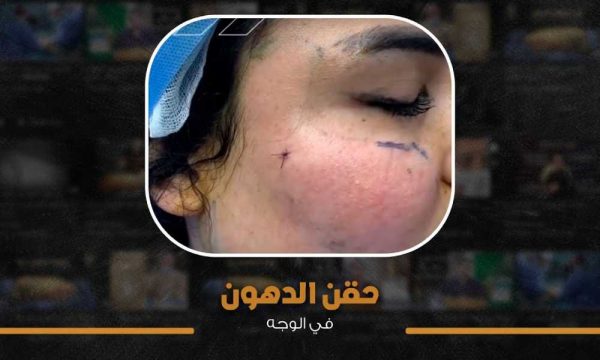 حقن دهون في الوجه
