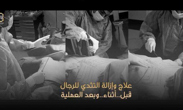 علاج التثدى للرجال