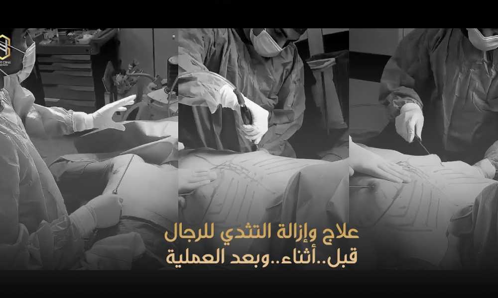 علاج التثدى للرجال