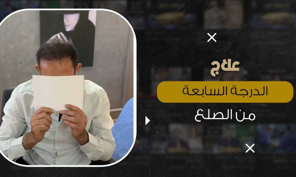 علاج الصلع الوراثي 2021
