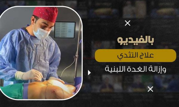 علاج تثدي الرجل