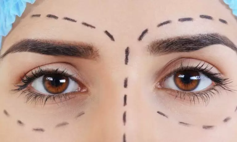 عملية شد الحواجب