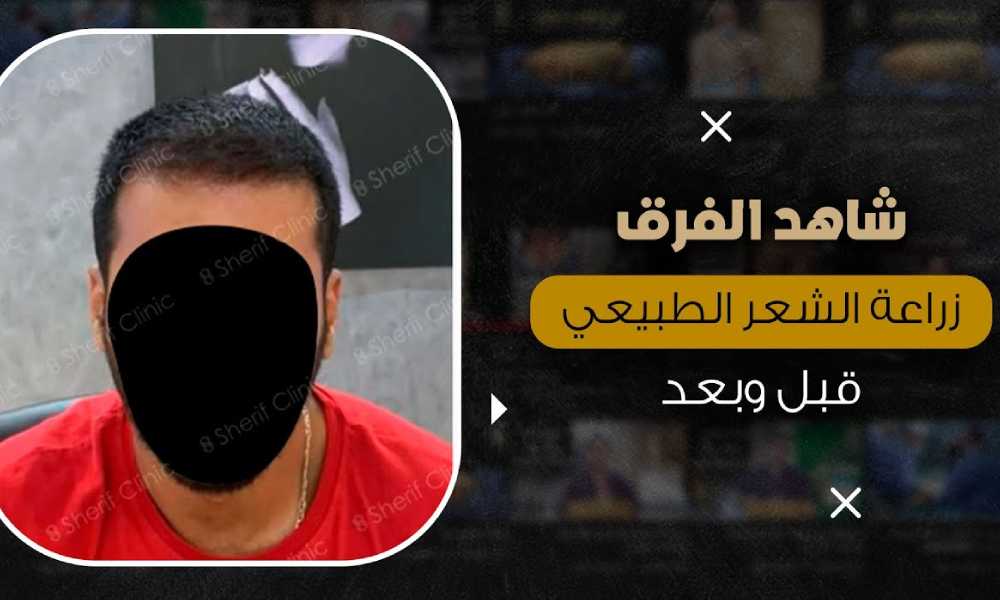 قبل وبعد زراعة الشعر