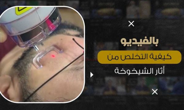 ليزر فراكشنال