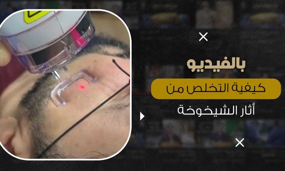 ليزر فراكشنال
