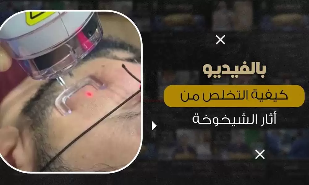 ليزر فراكشنال