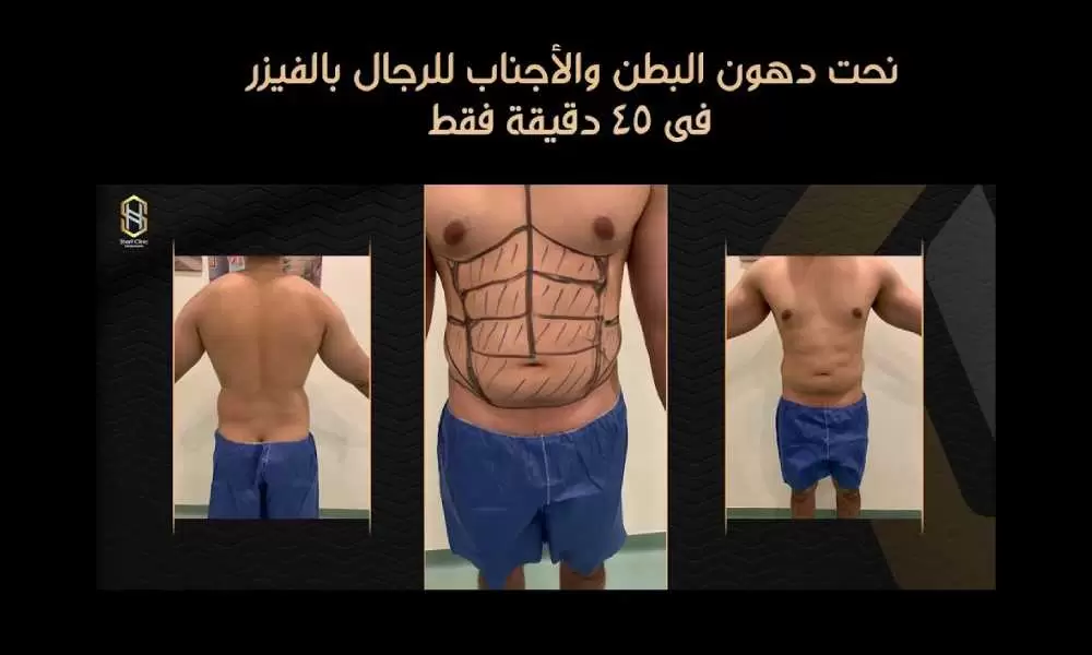 نحت البطن والخصر
