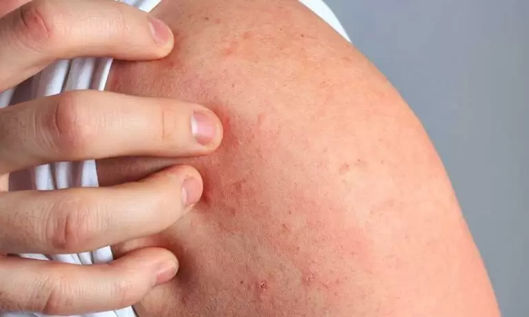 الحكه بعد عملية شفط الدهون