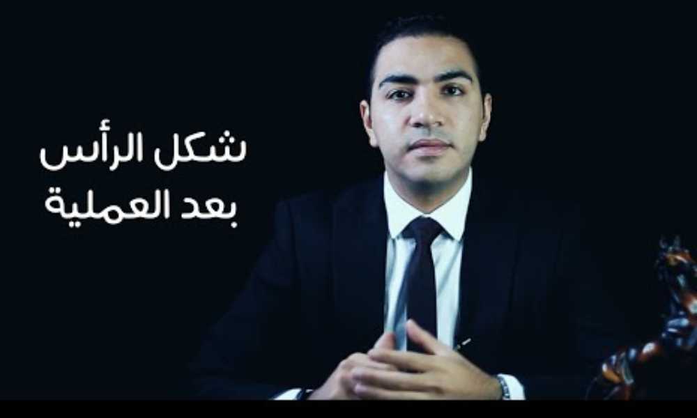 بعد زراعة الشعر